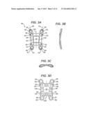 MIDFOOT BONE PLATE SYSTEM diagram and image