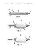 Methods of Stabilizing the Sacroiliac Joint diagram and image