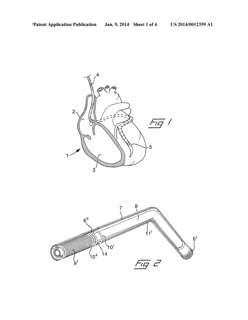 MEDICAL IMPLANTABLE LEAD - diagram, schematic, and image 02