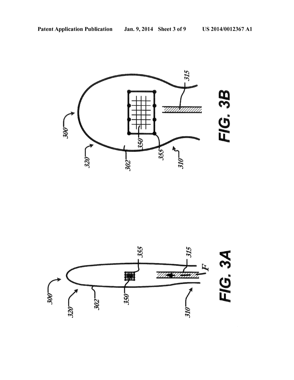 BALLOON SIZING DEVICE AND METHOD OF POSITIONING A PROSTHETIC HEART VALVE - diagram, schematic, and image 04