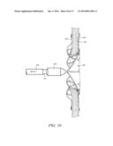 DEVICES AND METHODS FOR RETRIEVABLE INTRA-ATRIAL IMPLANTS diagram and image