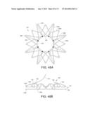 DEVICES AND METHODS FOR RETRIEVABLE INTRA-ATRIAL IMPLANTS diagram and image