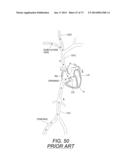 DEVICES AND METHODS FOR RETRIEVABLE INTRA-ATRIAL IMPLANTS diagram and image