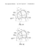 DEVICES AND METHODS FOR RETRIEVABLE INTRA-ATRIAL IMPLANTS diagram and image