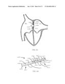 DEVICES AND METHODS FOR RETRIEVABLE INTRA-ATRIAL IMPLANTS diagram and image