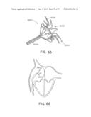 DEVICES AND METHODS FOR RETRIEVABLE INTRA-ATRIAL IMPLANTS diagram and image