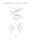 DEVICES AND METHODS FOR RETRIEVABLE INTRA-ATRIAL IMPLANTS diagram and image