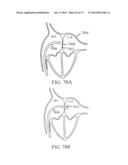 DEVICES AND METHODS FOR RETRIEVABLE INTRA-ATRIAL IMPLANTS diagram and image