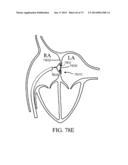 DEVICES AND METHODS FOR RETRIEVABLE INTRA-ATRIAL IMPLANTS diagram and image