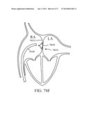 DEVICES AND METHODS FOR RETRIEVABLE INTRA-ATRIAL IMPLANTS diagram and image