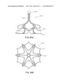 DEVICES AND METHODS FOR RETRIEVABLE INTRA-ATRIAL IMPLANTS diagram and image