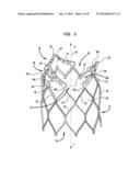 STENT AND IMPLANTABLE VALVE INCORPORATING SAME diagram and image