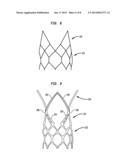 STENT AND IMPLANTABLE VALVE INCORPORATING SAME diagram and image