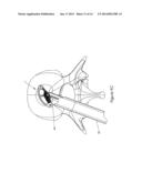 Intervertebral Spacer diagram and image