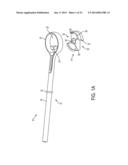 System for Articular Surface Replacement diagram and image