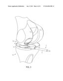 System for Articular Surface Replacement diagram and image