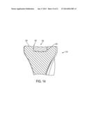 System for Articular Surface Replacement diagram and image