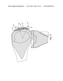 System for Articular Surface Replacement diagram and image