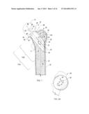 NECK SPARING TOTAL HIP IMPLANT SYSTEM diagram and image