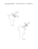 NECK SPARING TOTAL HIP IMPLANT SYSTEM diagram and image