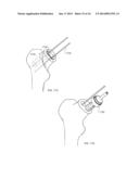 NECK SPARING TOTAL HIP IMPLANT SYSTEM diagram and image