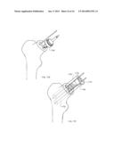 NECK SPARING TOTAL HIP IMPLANT SYSTEM diagram and image