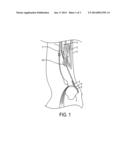 METHOD OF MENDING A GROINAL DEFECT diagram and image