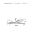 METHOD OF MENDING A GROINAL DEFECT diagram and image