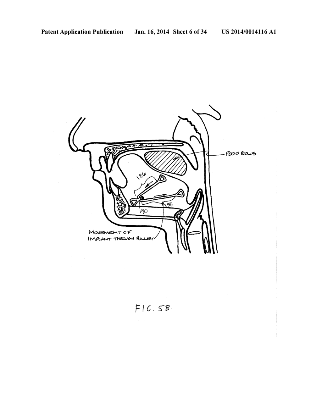 SYSTEMS AND METHODS FOR TREATMENT OF SLEEP APNEA - diagram, schematic, and image 07