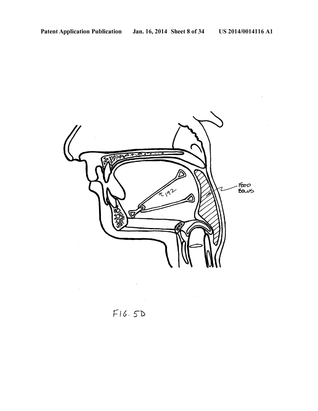 SYSTEMS AND METHODS FOR TREATMENT OF SLEEP APNEA - diagram, schematic, and image 09