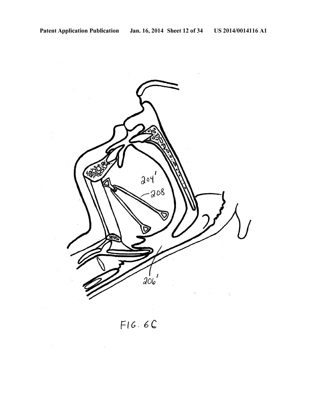 SYSTEMS AND METHODS FOR TREATMENT OF SLEEP APNEA - diagram, schematic, and image 13