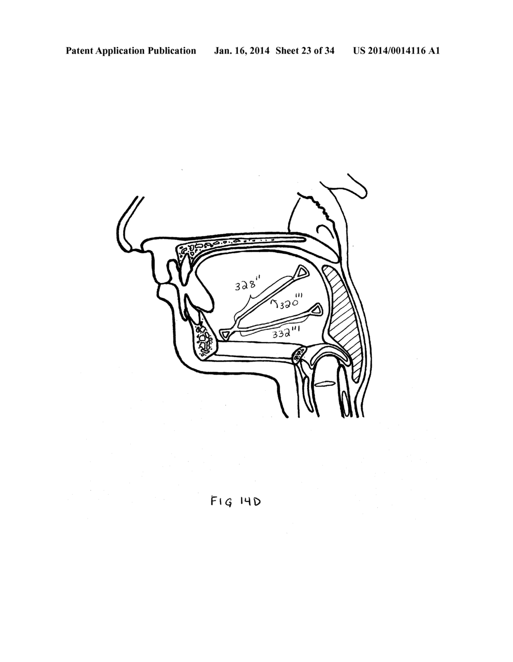 SYSTEMS AND METHODS FOR TREATMENT OF SLEEP APNEA - diagram, schematic, and image 24