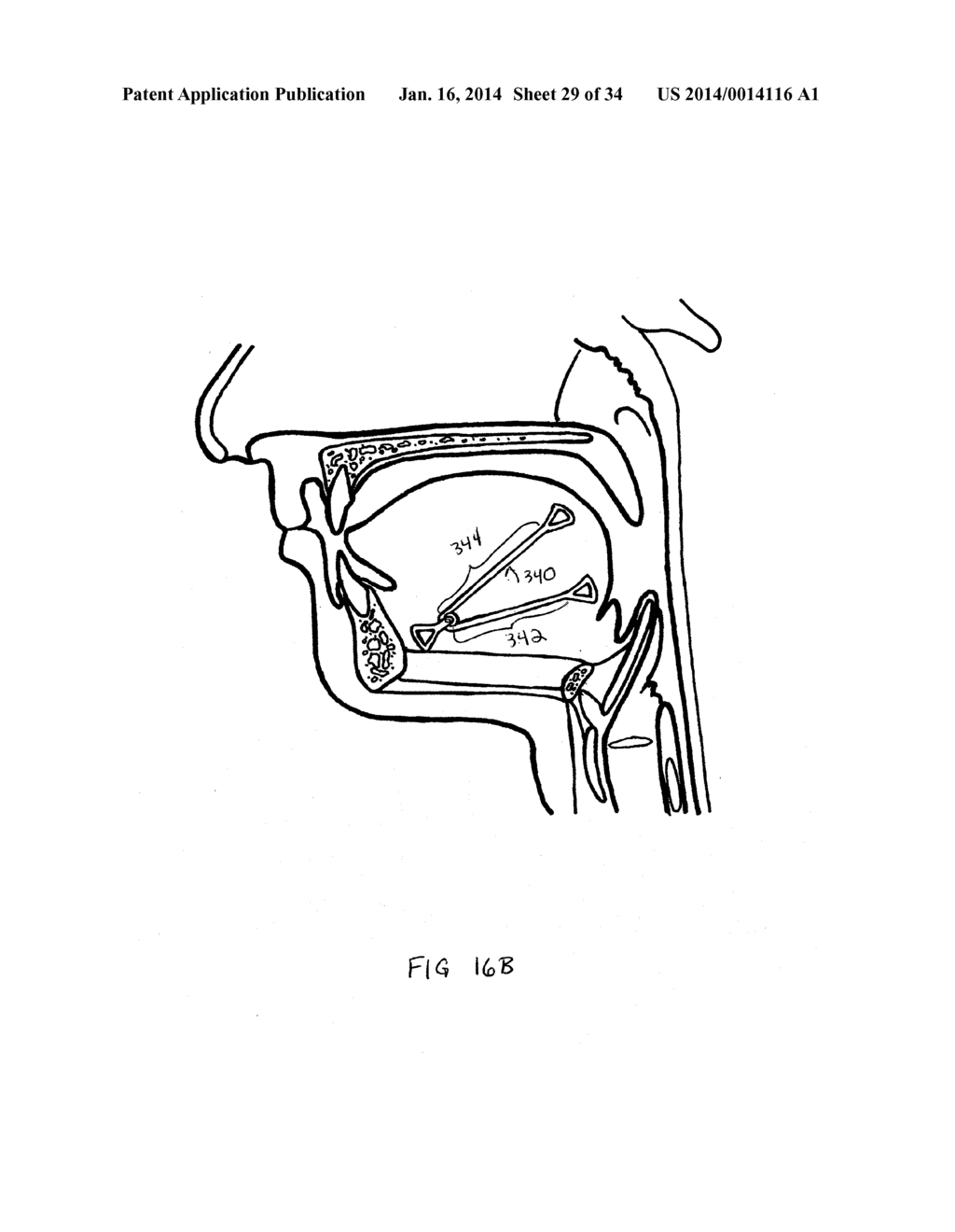 SYSTEMS AND METHODS FOR TREATMENT OF SLEEP APNEA - diagram, schematic, and image 30