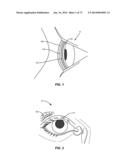 APPARATUSES AND METHODS FOR DETERMINING TEAR FILM BREAK-UP TIME AND/OR FOR     DETECTING LID MARGIN CONTACT AND BLINK RATES, PARTICULARY FOR DIAGNOSING,     MEASURING, AND/OR ANALYZING DRY EYE  CONDITIONS AND SYMPTOMS diagram and image