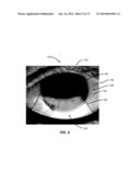 APPARATUSES AND METHODS FOR DETERMINING TEAR FILM BREAK-UP TIME AND/OR FOR     DETECTING LID MARGIN CONTACT AND BLINK RATES, PARTICULARY FOR DIAGNOSING,     MEASURING, AND/OR ANALYZING DRY EYE  CONDITIONS AND SYMPTOMS diagram and image