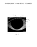 APPARATUSES AND METHODS FOR DETERMINING TEAR FILM BREAK-UP TIME AND/OR FOR     DETECTING LID MARGIN CONTACT AND BLINK RATES, PARTICULARY FOR DIAGNOSING,     MEASURING, AND/OR ANALYZING DRY EYE  CONDITIONS AND SYMPTOMS diagram and image