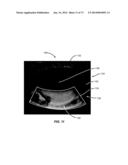 APPARATUSES AND METHODS FOR DETERMINING TEAR FILM BREAK-UP TIME AND/OR FOR     DETECTING LID MARGIN CONTACT AND BLINK RATES, PARTICULARY FOR DIAGNOSING,     MEASURING, AND/OR ANALYZING DRY EYE  CONDITIONS AND SYMPTOMS diagram and image