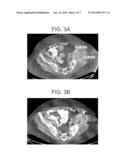 METHODS OF TREATMENT OF SOLID TUMORS USING COENZYME Q10 diagram and image