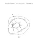 BARIATRIC DEVICE AND METHOD diagram and image