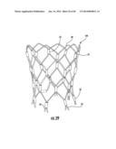 BARIATRIC DEVICE AND METHOD diagram and image