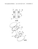 BARIATRIC DEVICE AND METHOD diagram and image