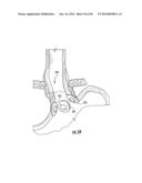 BARIATRIC DEVICE AND METHOD diagram and image