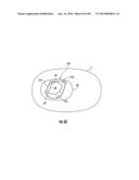 BARIATRIC DEVICE AND METHOD diagram and image