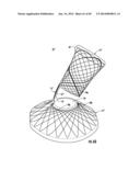 BARIATRIC DEVICE AND METHOD diagram and image