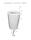 BARIATRIC DEVICE AND METHOD diagram and image