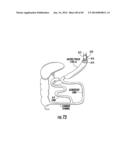 BARIATRIC DEVICE AND METHOD diagram and image