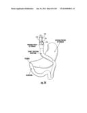 BARIATRIC DEVICE AND METHOD diagram and image