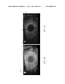 IONIZING RADIATION DETECTOR FOR USE WITH ENDOSCOPIC ULTRASOUND diagram and image