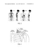 METHODS AND DEVICES FOR ACTIVATING BROWN ADIPOSE TISSUE WITH TARGETED     SUBSTANCE DELIVERY diagram and image