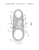 Devices and Systems for Carotid Body Ablation diagram and image